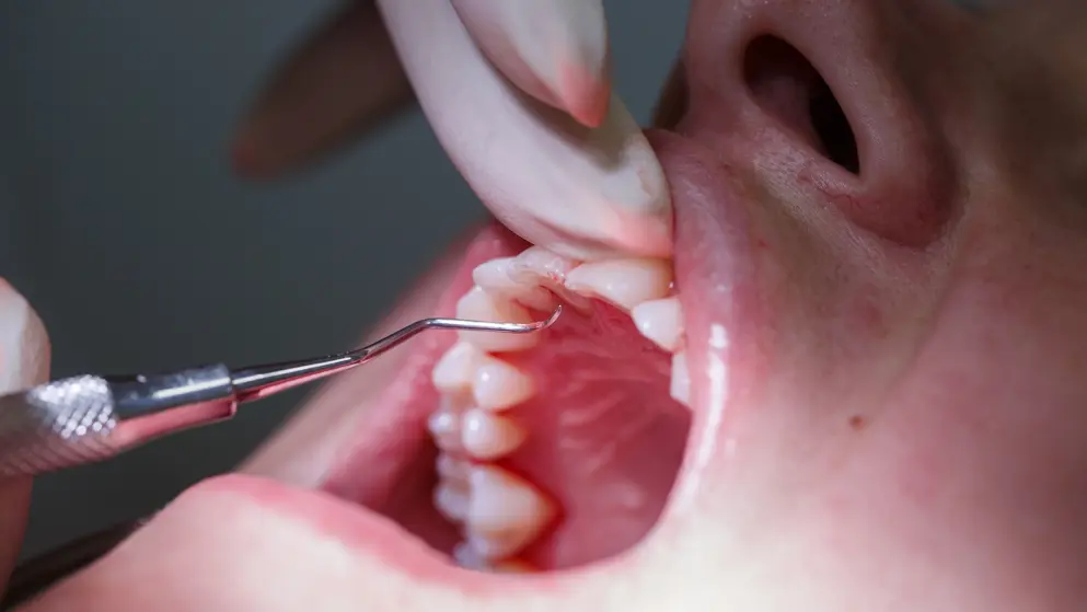 Patient at dental hygienists office; bleeding gums, periodontitis