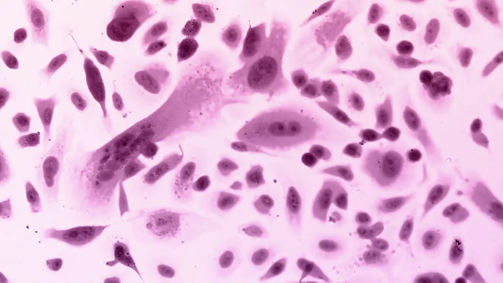 Photo of Prostate cancer cells under microscope, pink and purple tones.