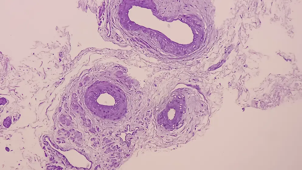 Prostatic tissue biopsy; Sections show fatty tissue, neural tissue and muscle tissue; Prostate cancer diagnosis