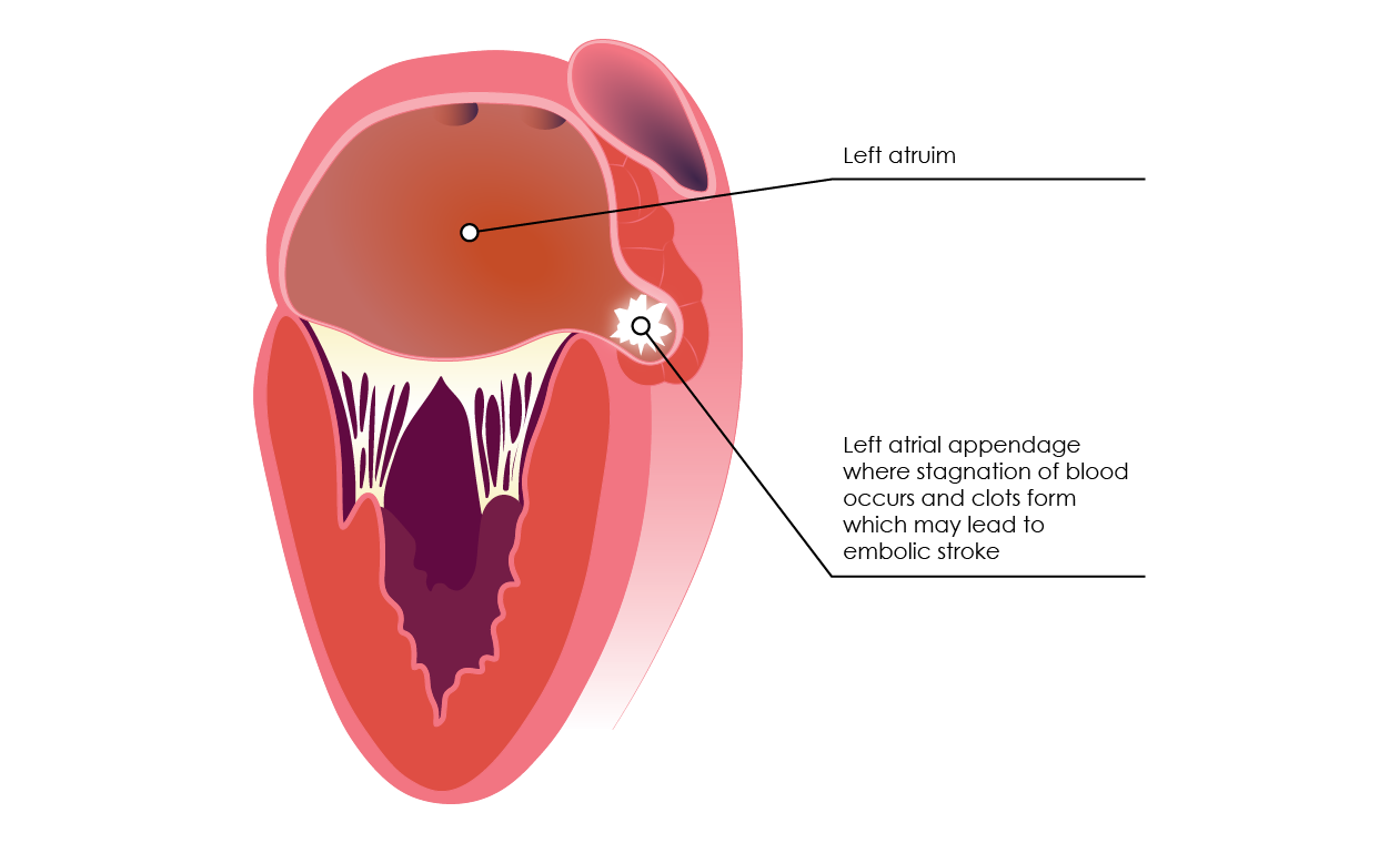 Disease Awareness | Stroke Prevention | Medthority.com