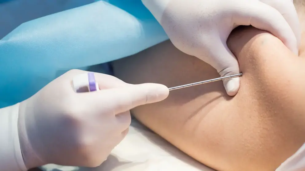 Close up of a lumbar puncture; spinal needle; white gloves