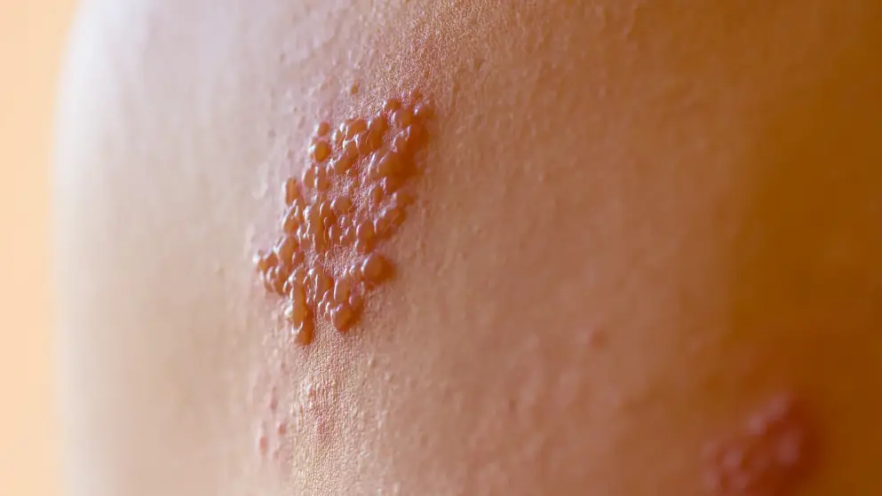 Close up of a shingle flare up on pale skin; blistering rash