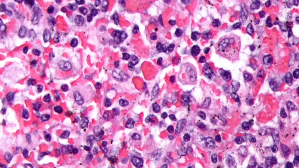 Micrograph showing red blood cells within macrophages; H&E stain