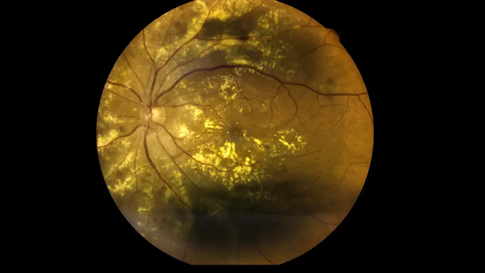 A slit-lamp test image of the back of a human eye, displaying macular degeneration