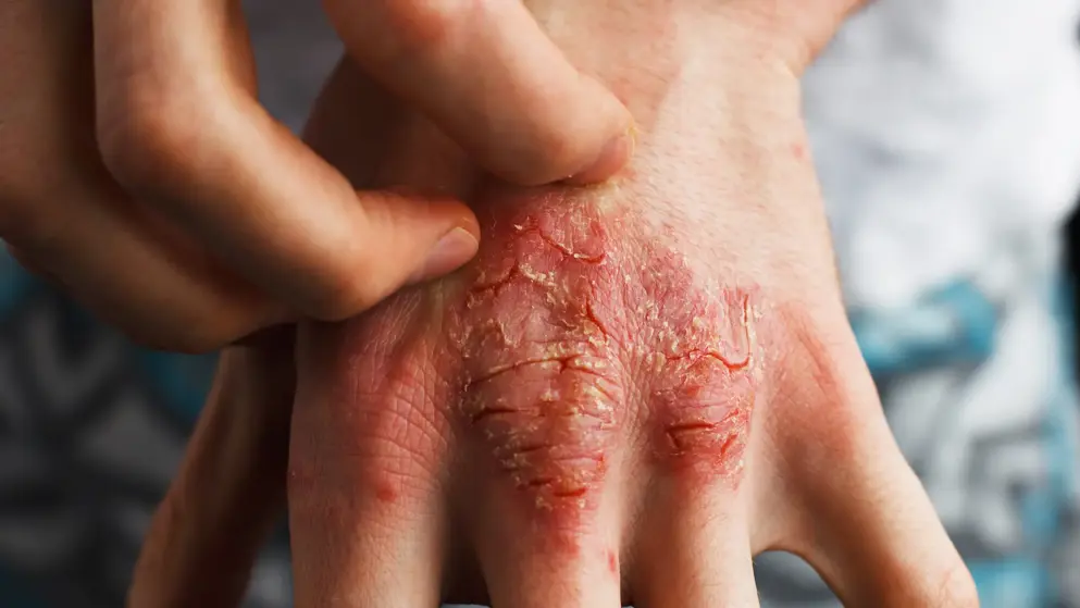 Photo of adult hands with the knuckles cracked and bleeding from severe psoriasis