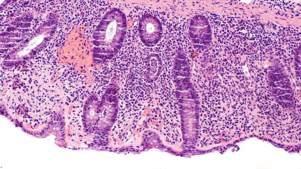 Tissue slice of human intestine displaying ulcerative holes due to colitis